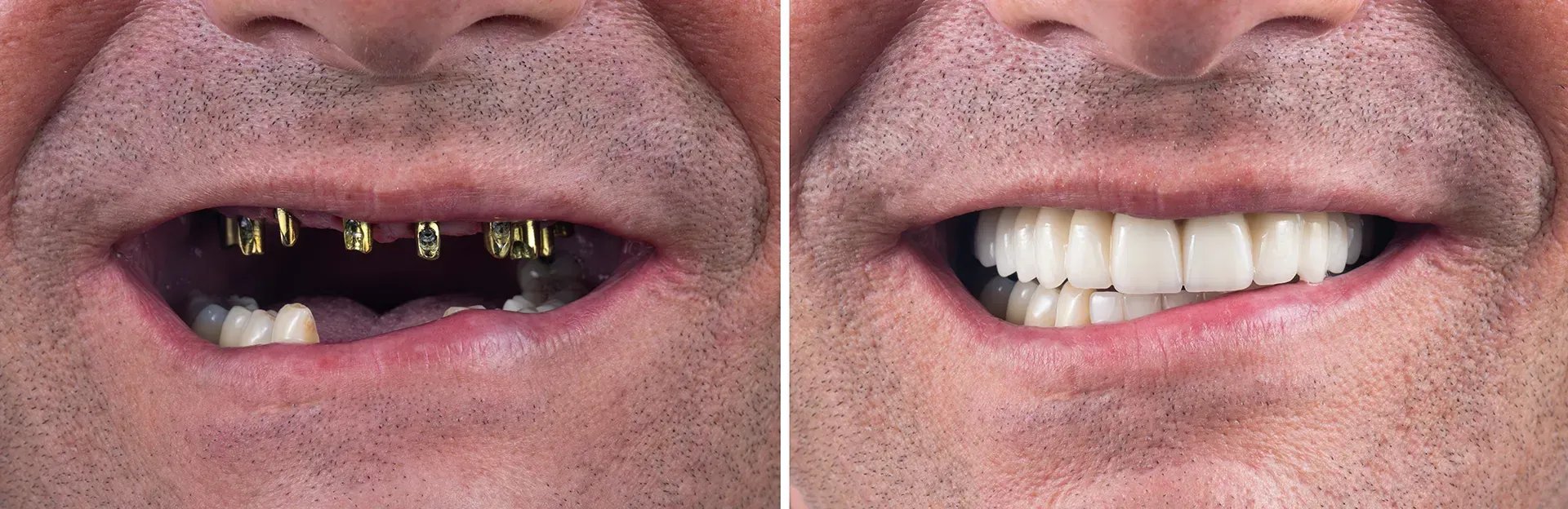 A before and after picture of a man 's teeth