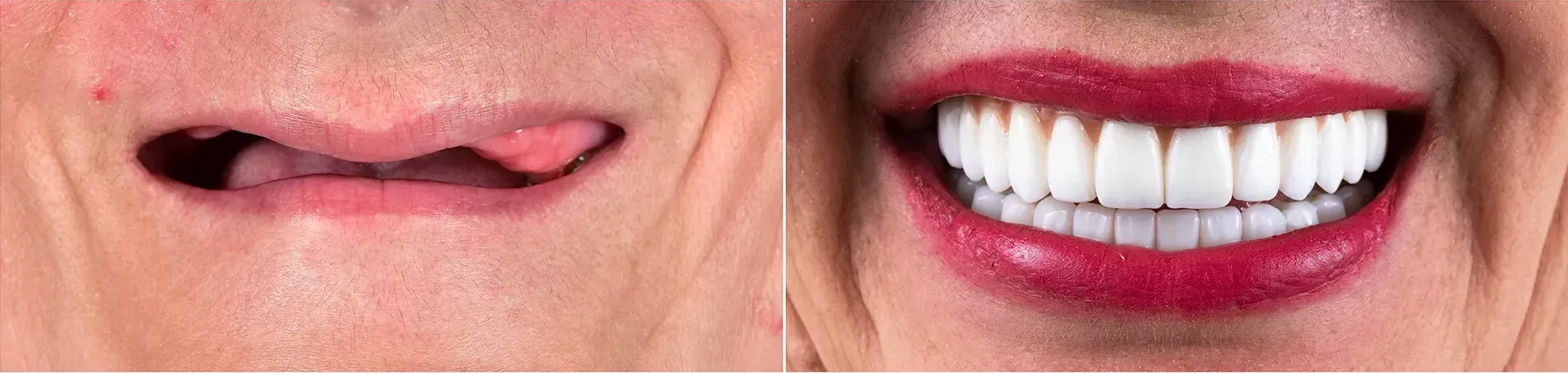 A woman 's mouth with a missing tooth and a woman 's mouth with white teeth and red lips.