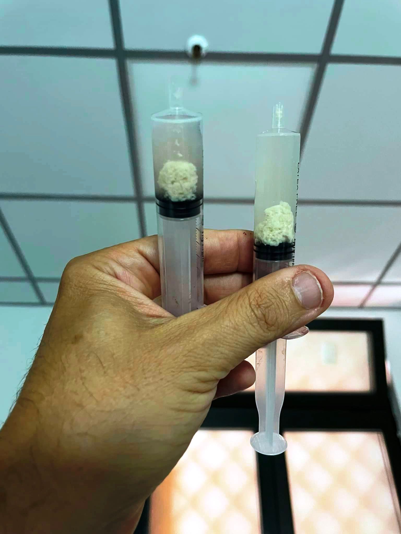 Trattamento di Litoclasia Ecoguidata della spalla