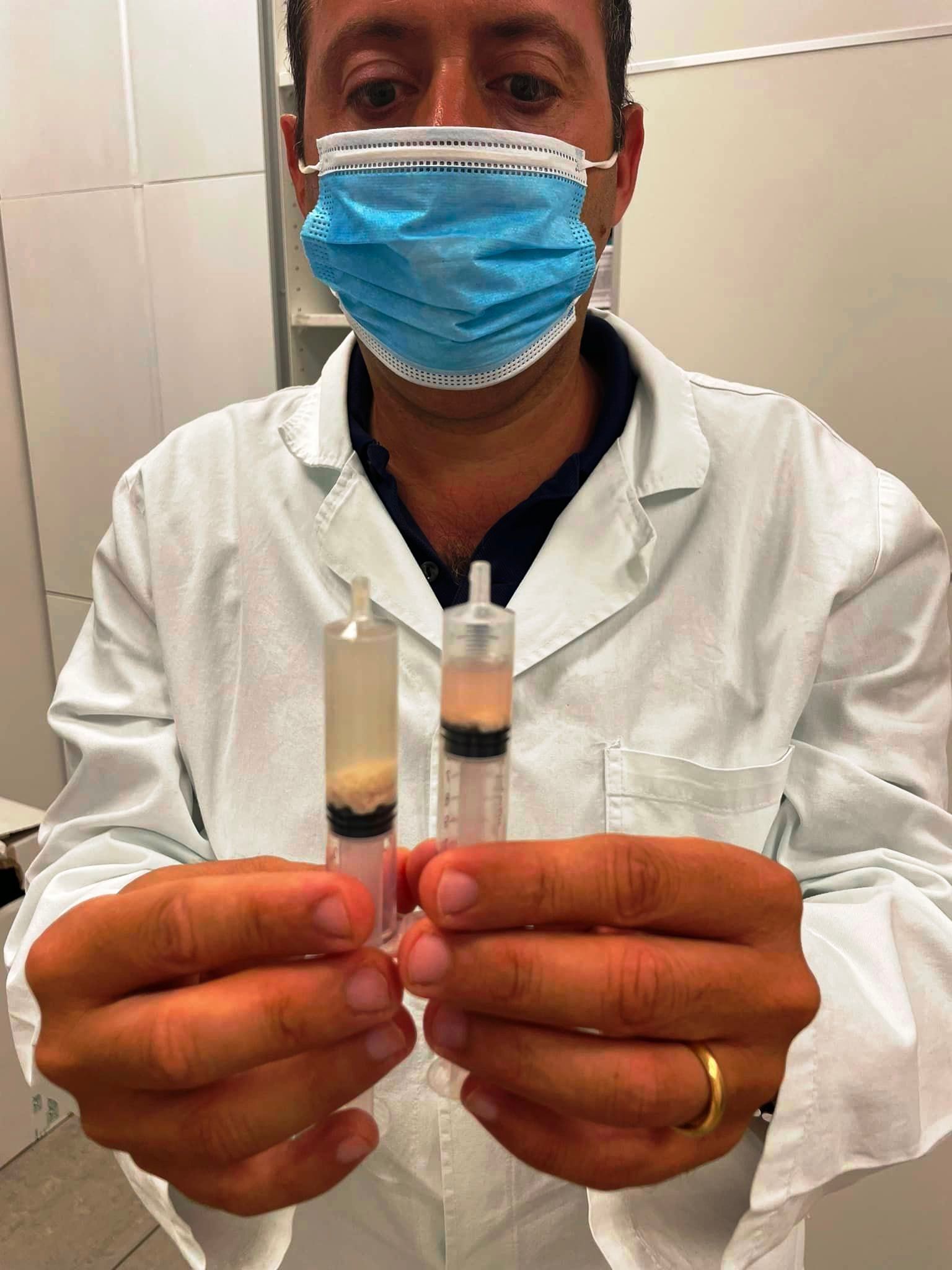 Trattamento di Litoclasia Ecoguidata della spalla