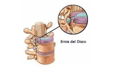 Ernia del disco