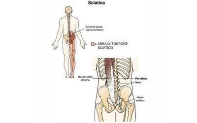 Sciatica