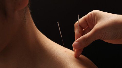acupuncture treatment in Wakefield