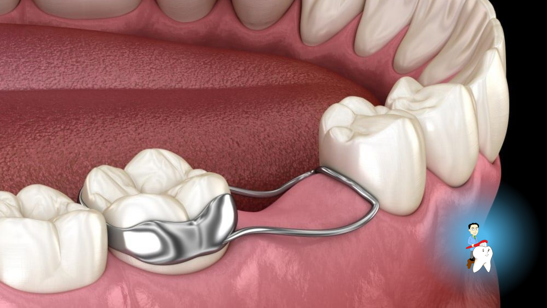 A close up of a person 's teeth with a brace on them.