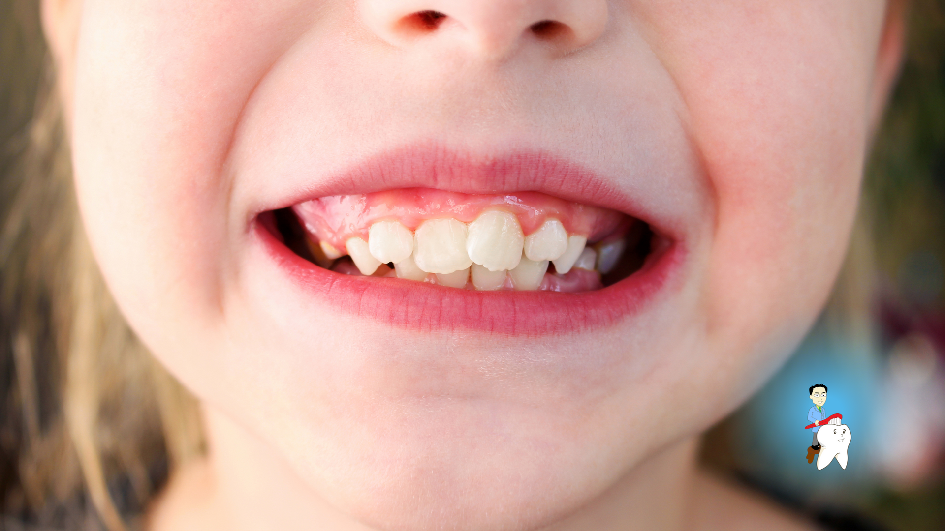 A close up of a child 's mouth with a tooth missing.