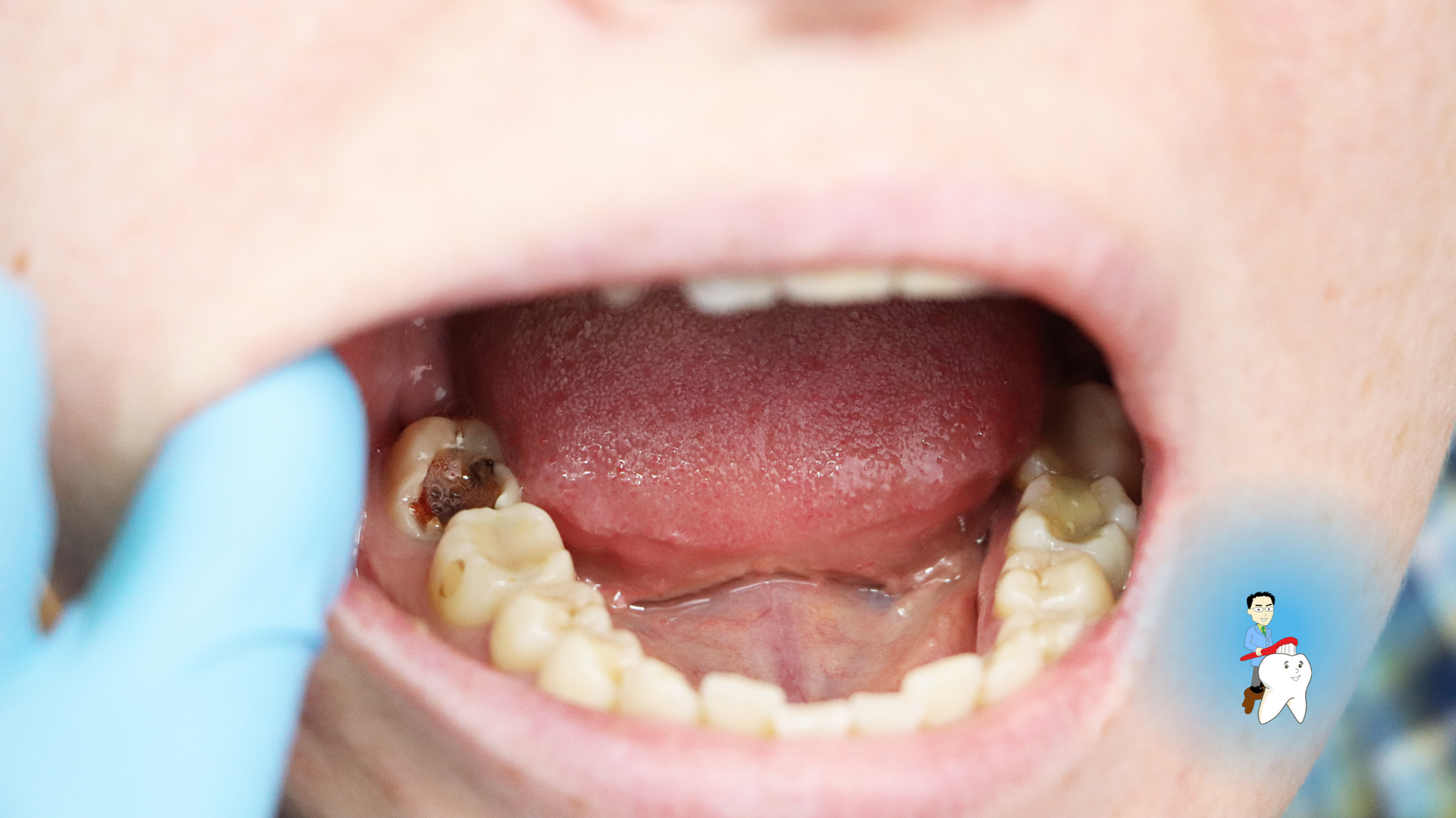 A close up of a person 's mouth with a tooth missing.