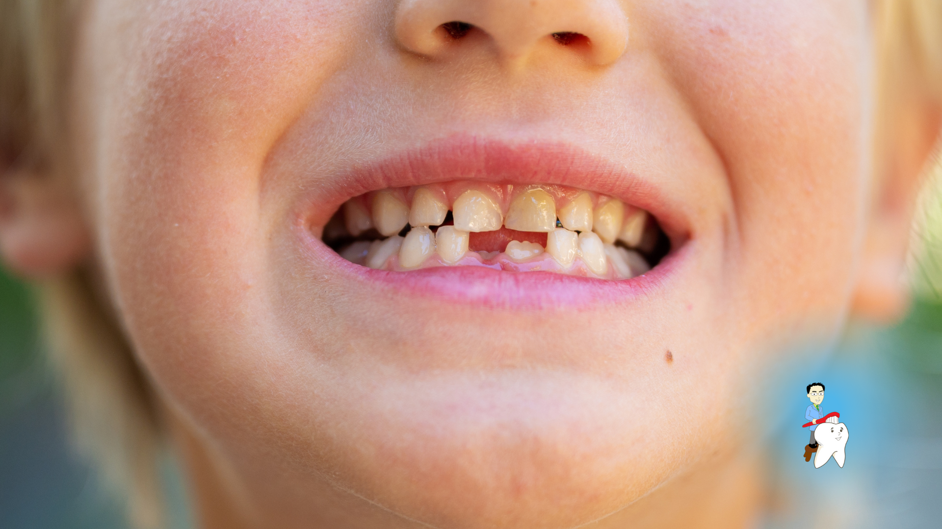 A close up of a child 's mouth with a missing tooth.