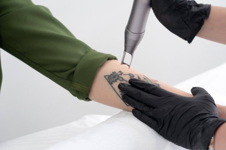 How Tattoo Removal Works  Forefront Dermatology