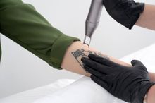 tattoo removal services in Louisville, KY