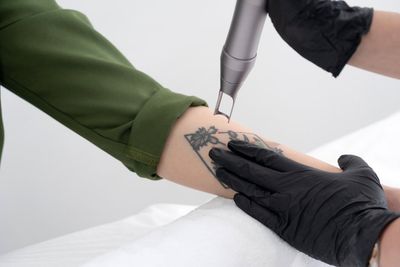 Take It Off Laser Tattoo Removal  Louisville KY 40223