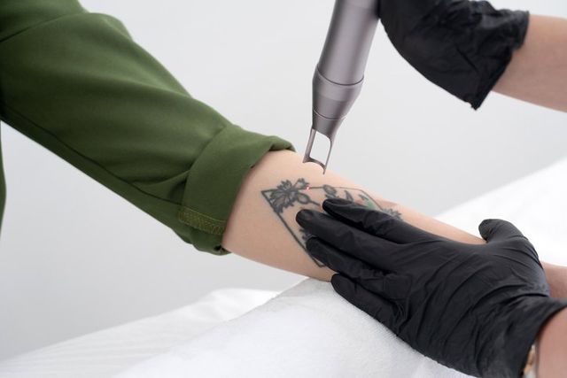 Tattoo Removal in Louisville KY  Removery