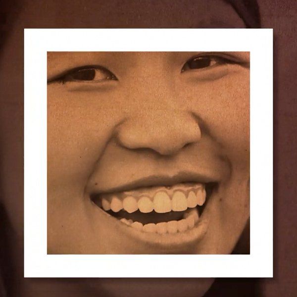 Treating and Preventing Acne Scars