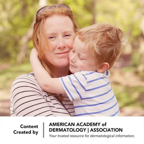 Things you should know about a rosacea diagnosis