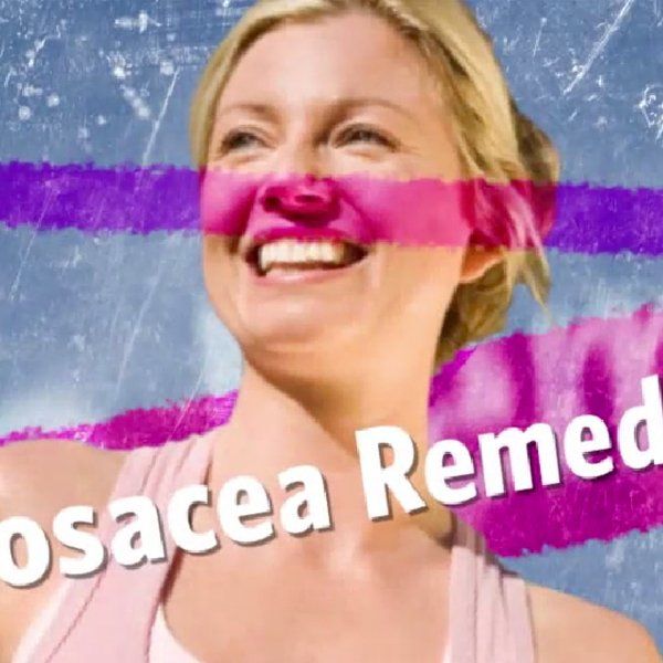 ROSACEA REMEDIES