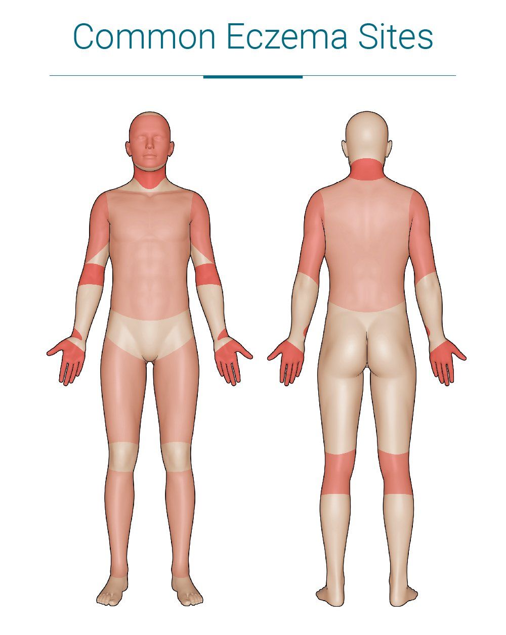 Common Eczema Sites