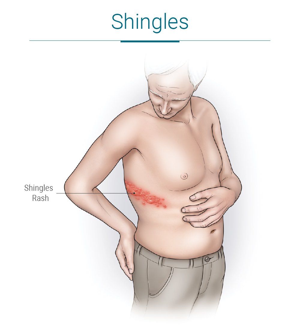 Shingles Medical Illustration