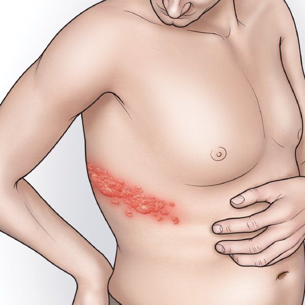 Shingles Medical illustration