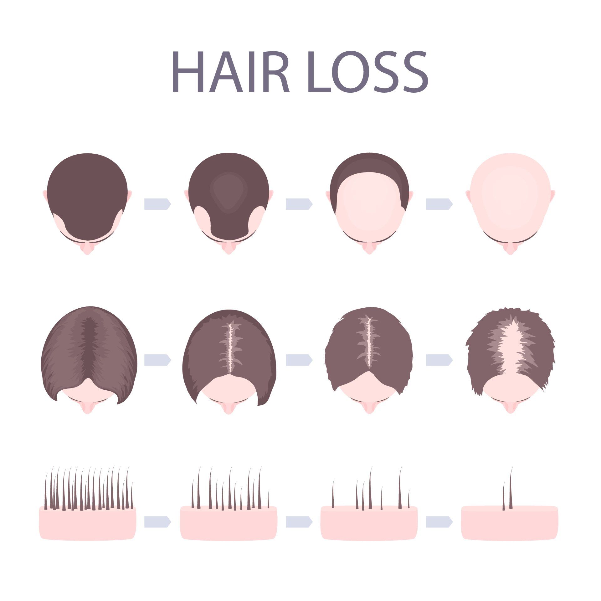 hair loss illustration