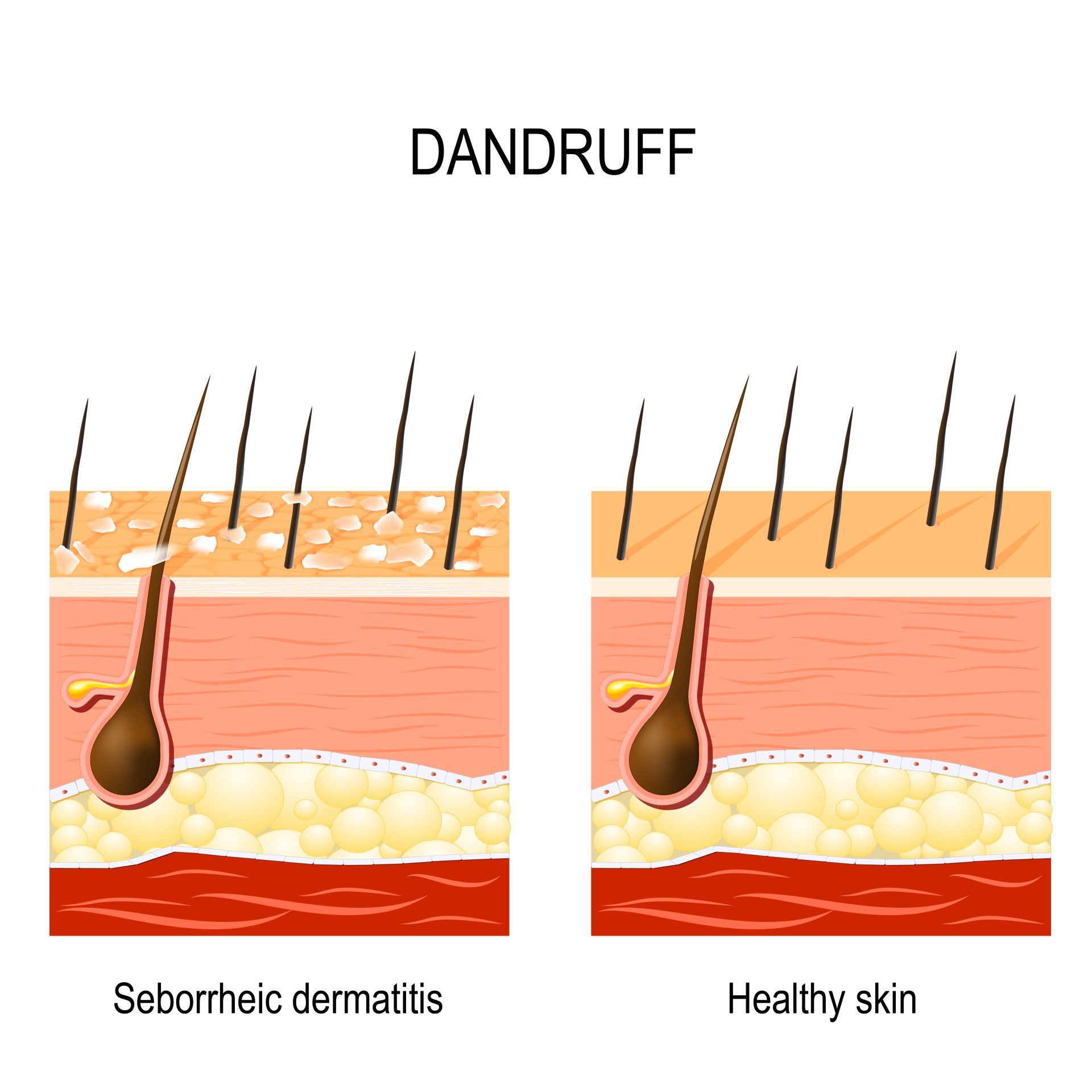 dandruff illustration