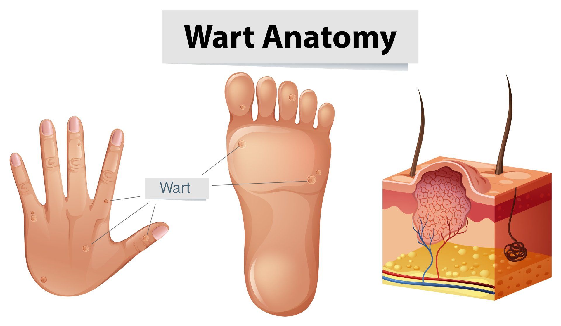 Wart Anatomy