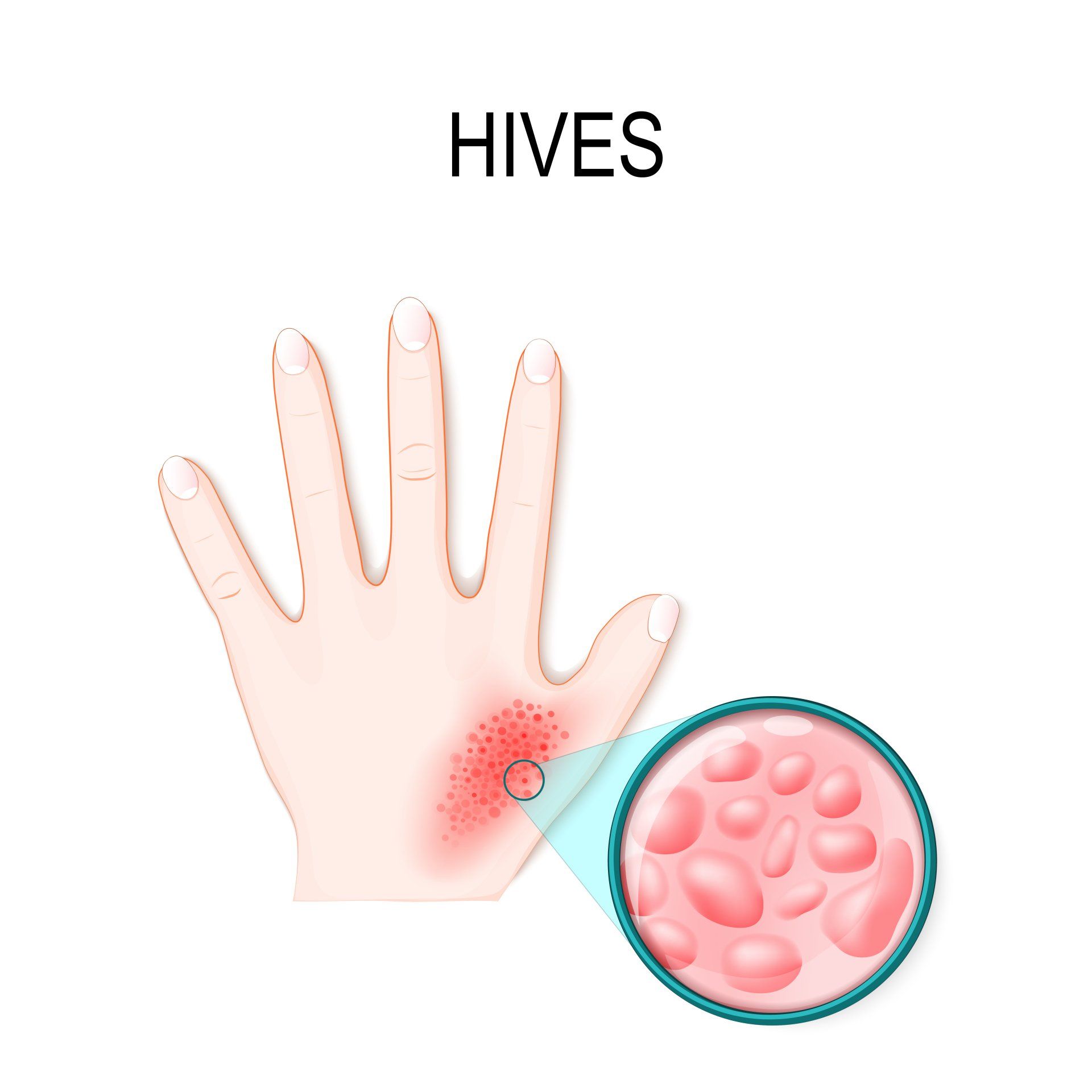 Hives Illustration