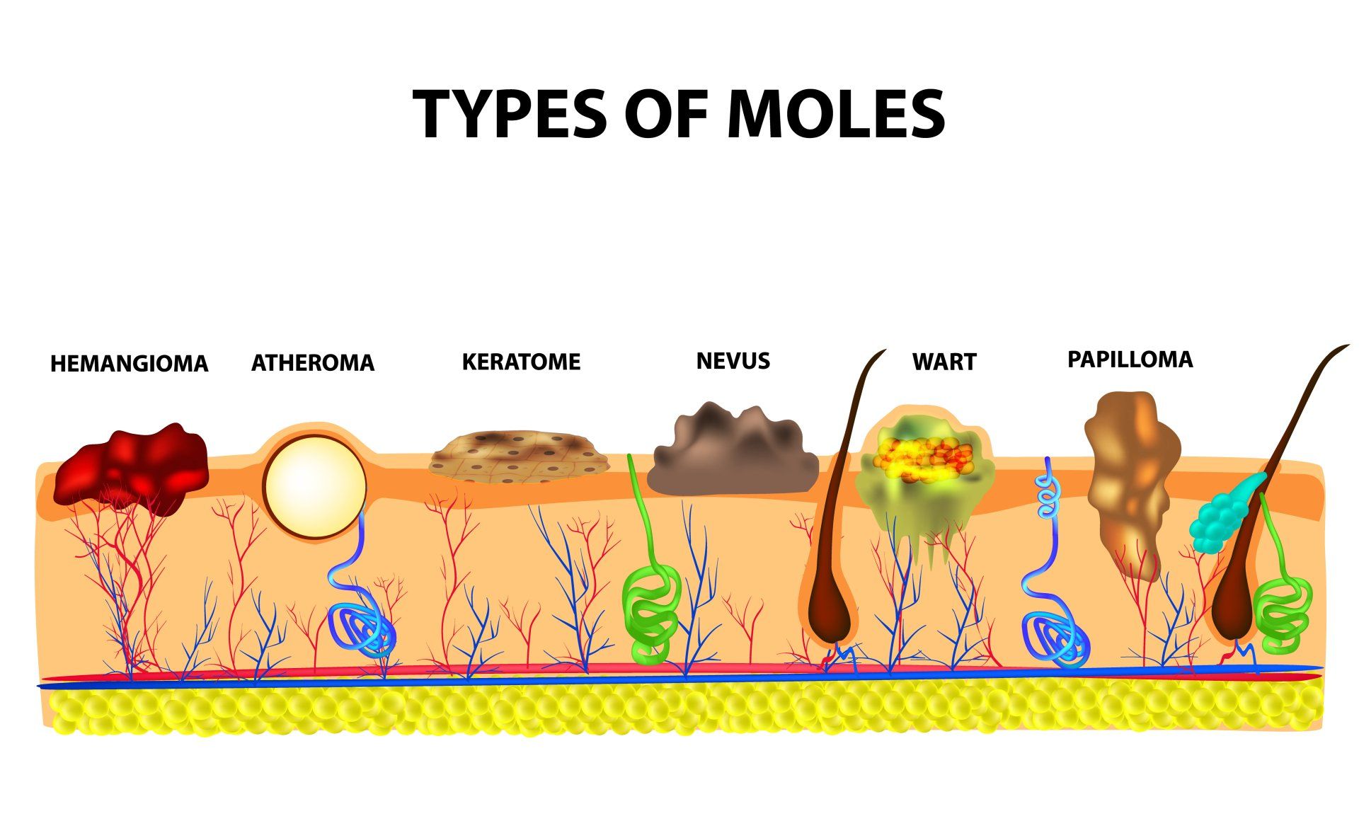 Types of Moles Ilustration