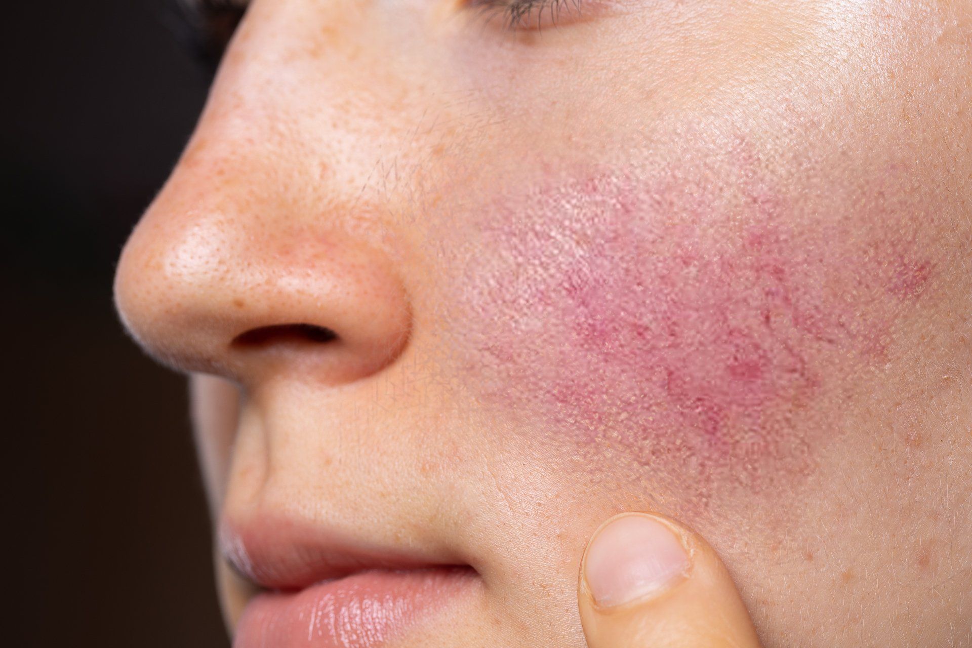 COMPLETE GUIDE TO ROSACEA