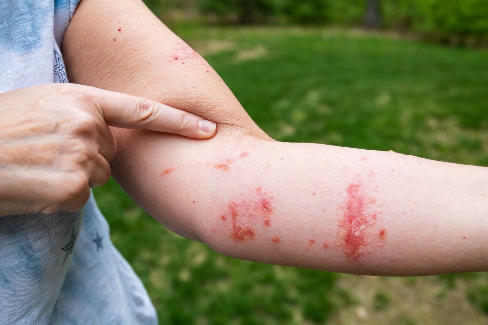 pictures-of-poison-ivy-rash-on-humans-at-robert-lieu-blog