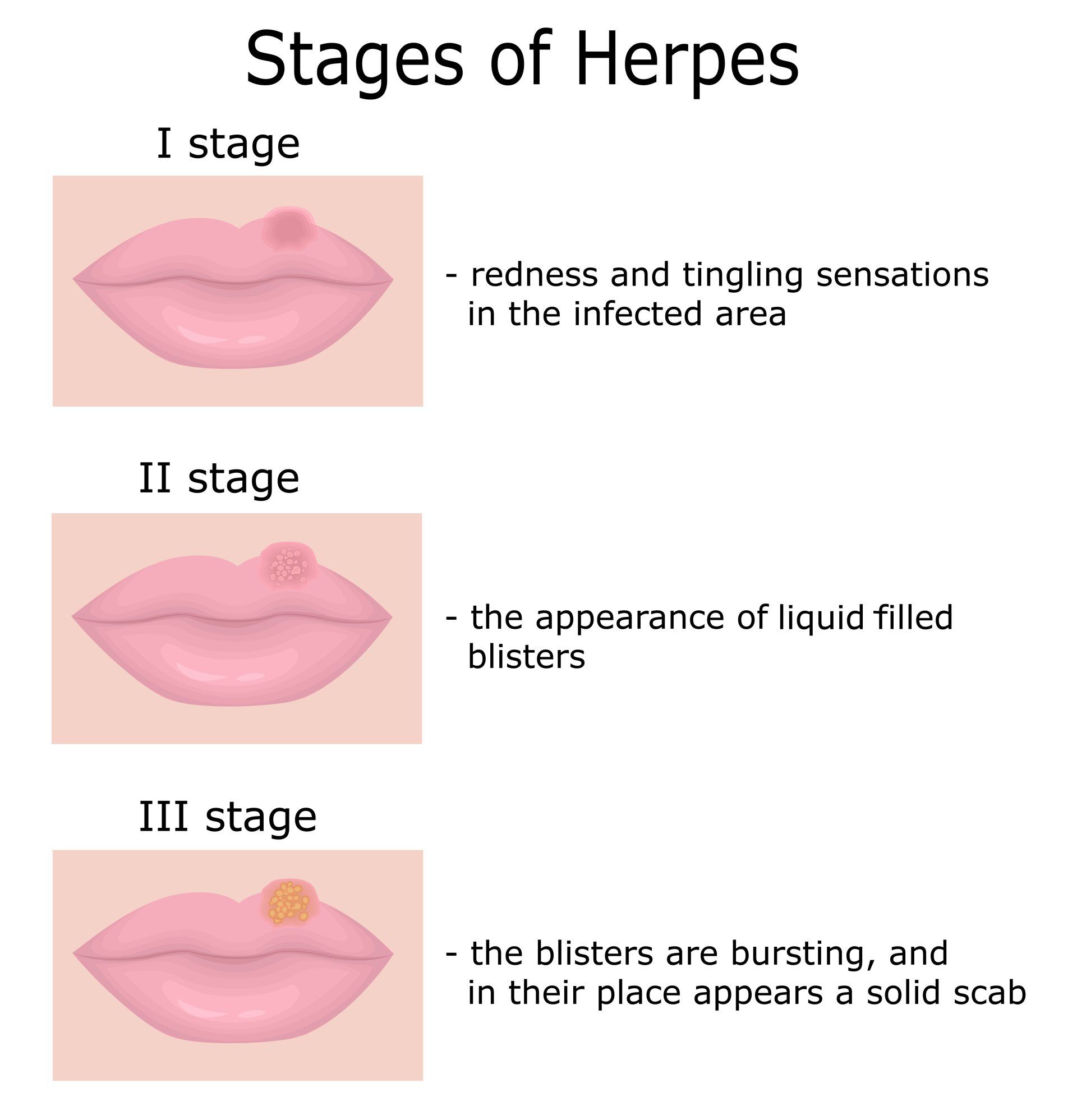 Herpes Pornstars