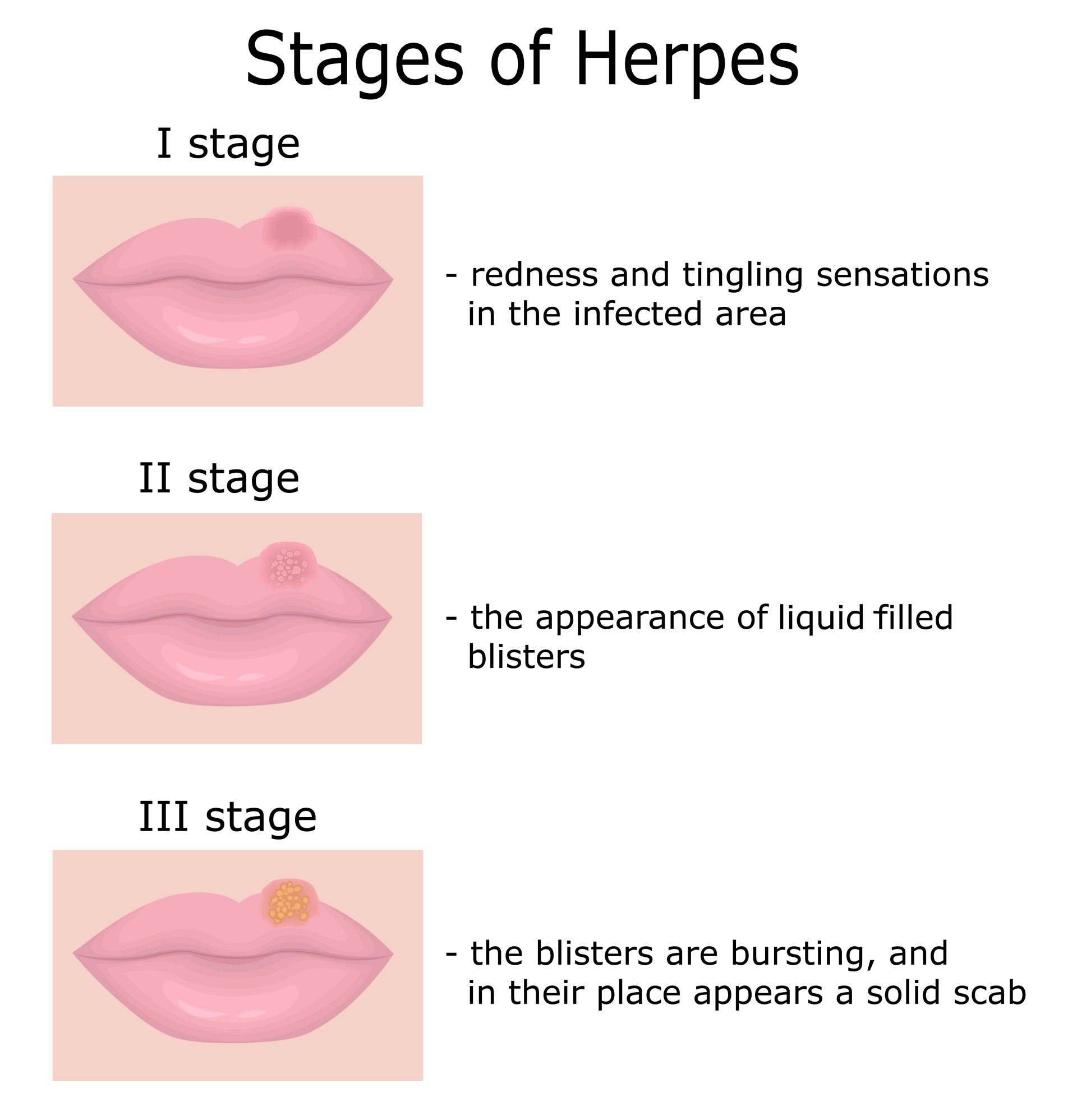 Stages of Herpes Illustration