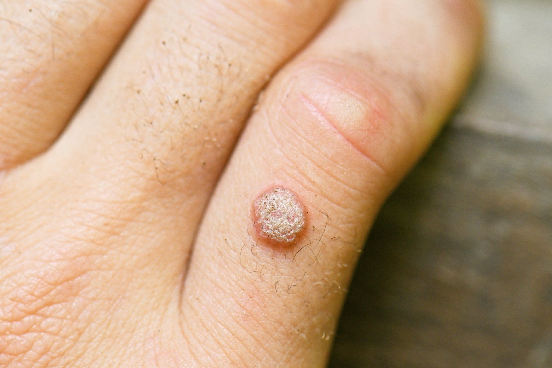 COMPLETE GUIDE TO WARTS