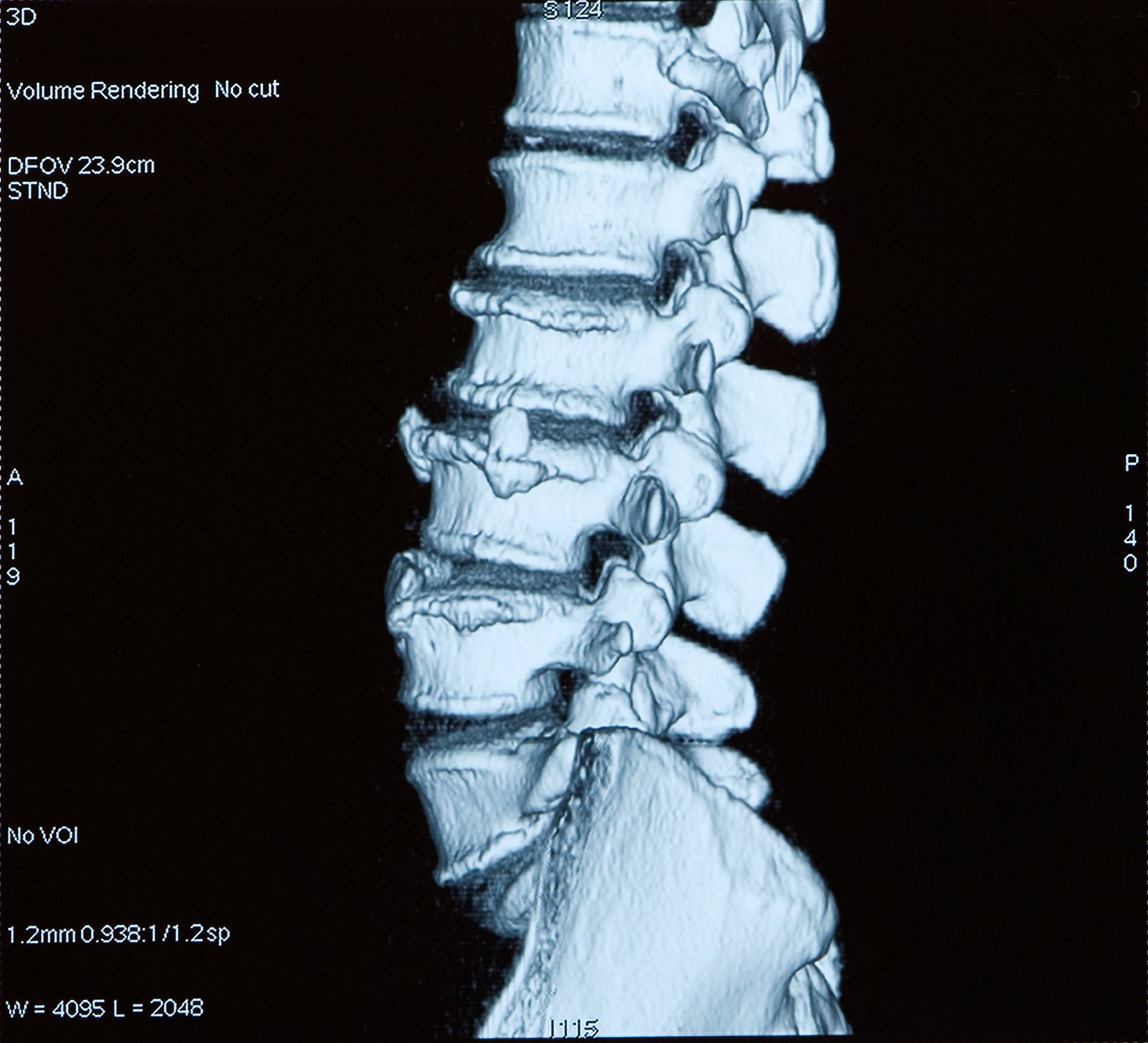 A ct scan of the spine of a person