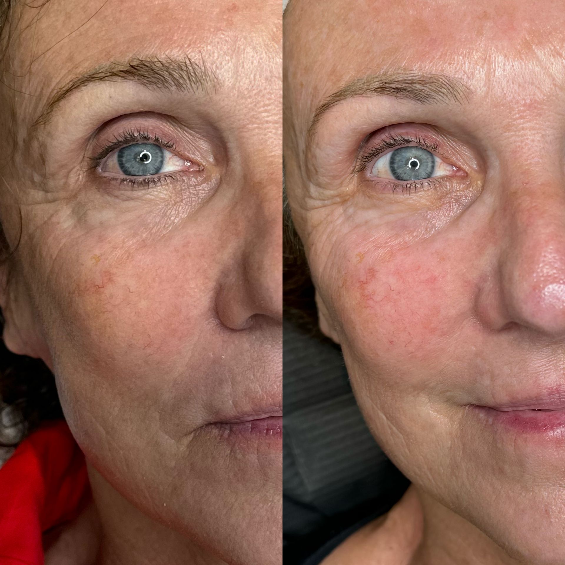 A before and after photo of a woman 's face with blue eyes.