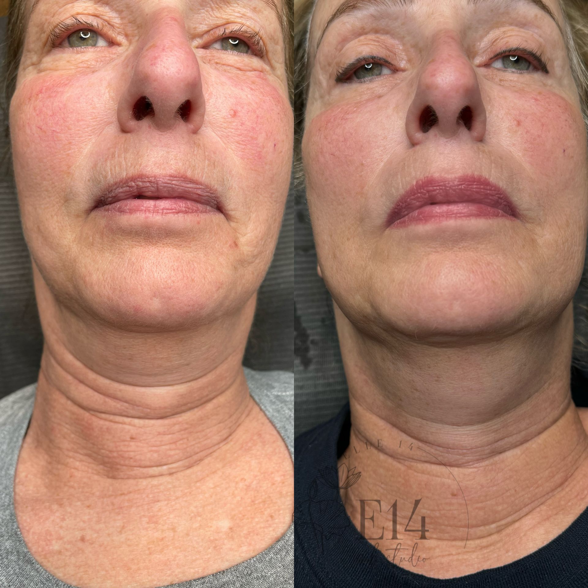 A before and after photo of a woman 's neck and face.