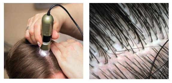 Dispositivo per il trattamento del cuoio capelluto applicato ai capelli, che mostra un primo piano del cuoio capelluto separato e dei sottili capelli sotto la sonda.