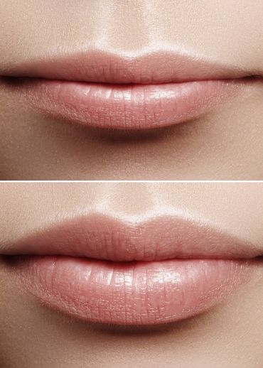 Lippen aufspritzen, Hyaluronsäure Lippen, Lippenvolumen, Hyaluronsäure, Hyaluron