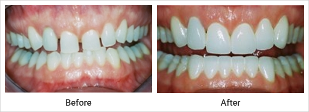Porcelain Veneers & Crowns