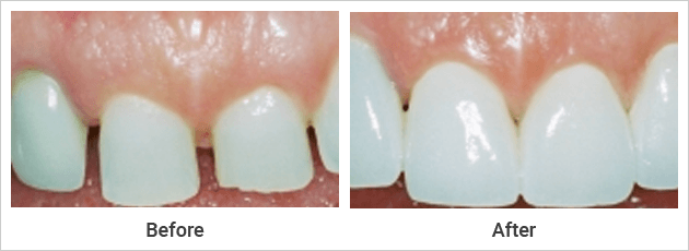 Porcelain Veneers
