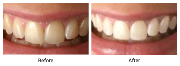 Teeth Whitening