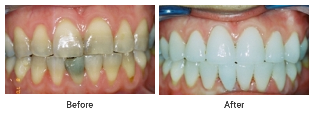 Porcelain Veneers