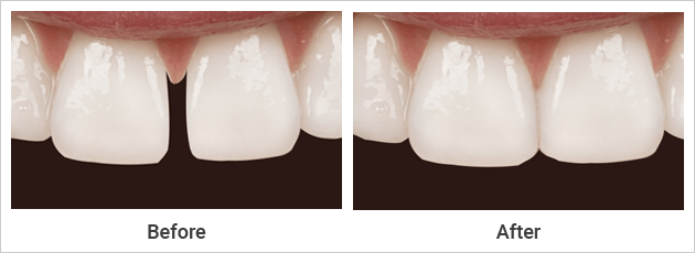 Porcelain Veneers