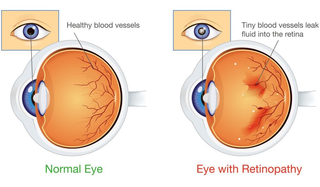 Diagram comparing a normal eye to an eye with retinopathy; one shows healthy blood vessels, the other shows leakage.