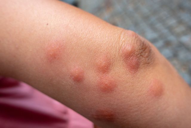 mosquito bite allergic reaction