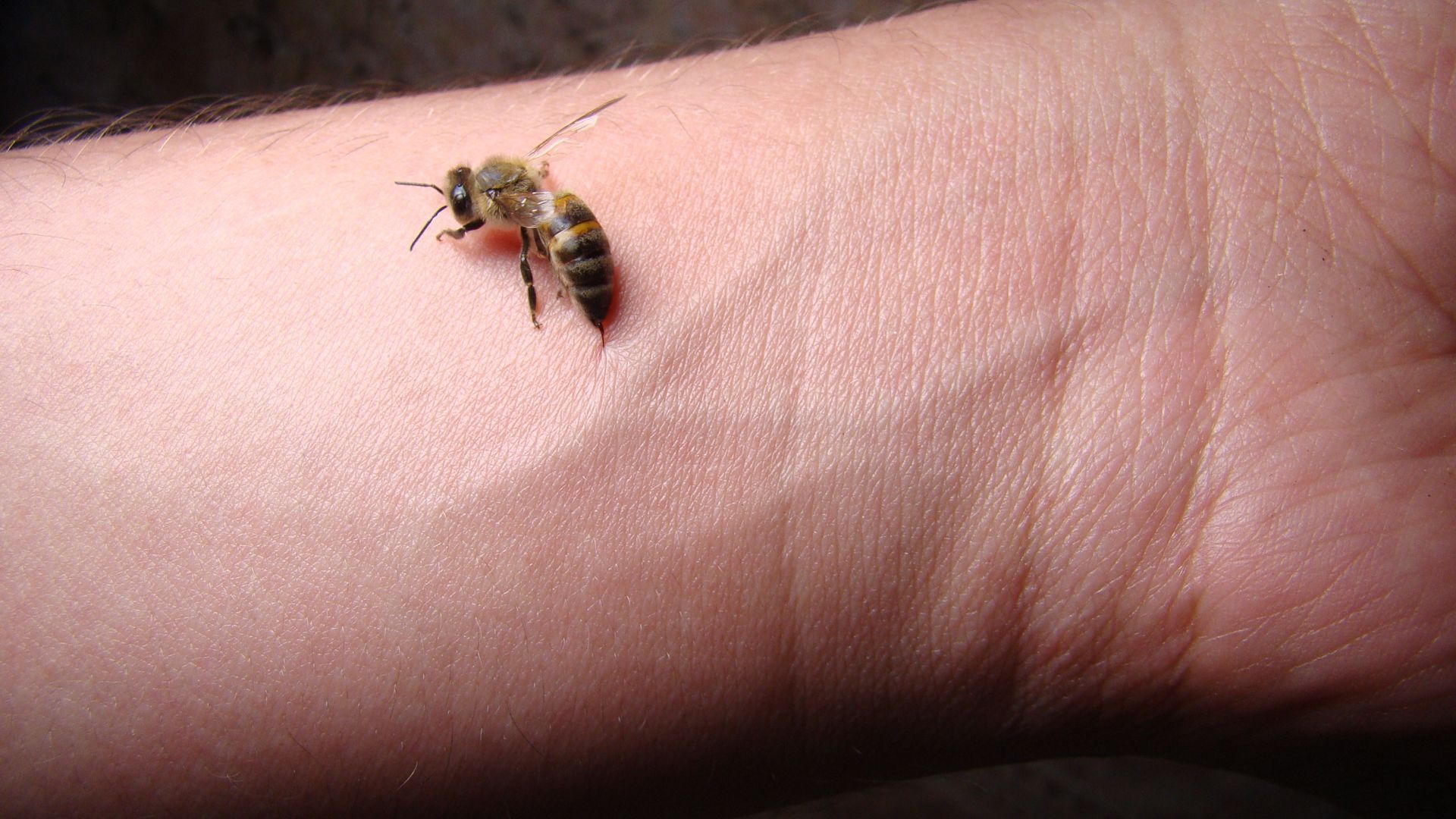 bee sting