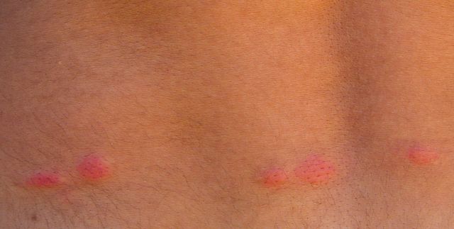 What's the Difference Between Flea Bites vs Bed Bug Bites?