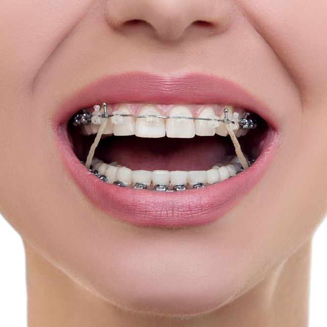 woman with braces and rubber bands