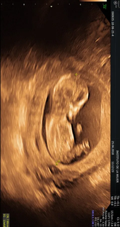 imagen de feto