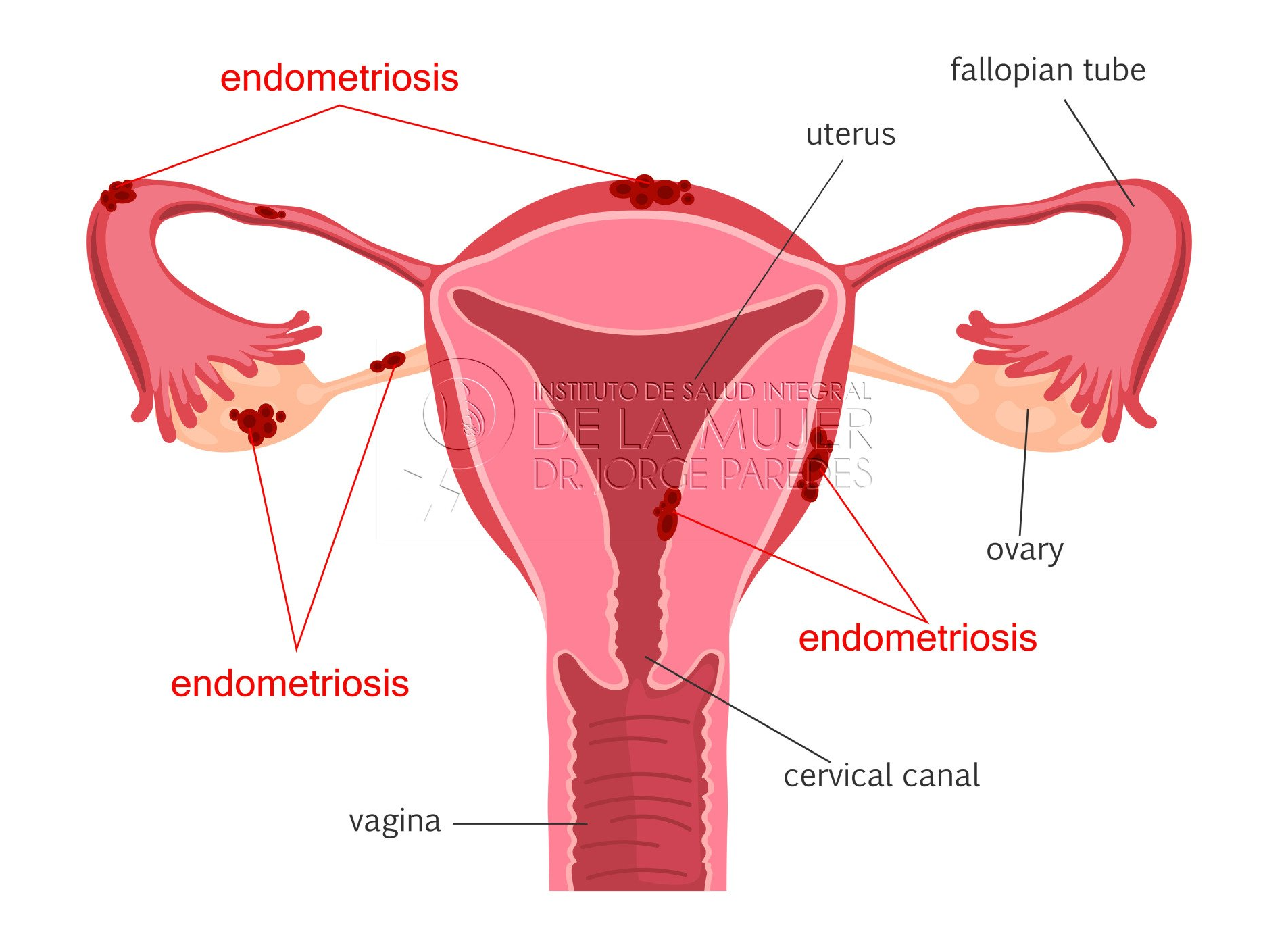 Útero con endometriosis