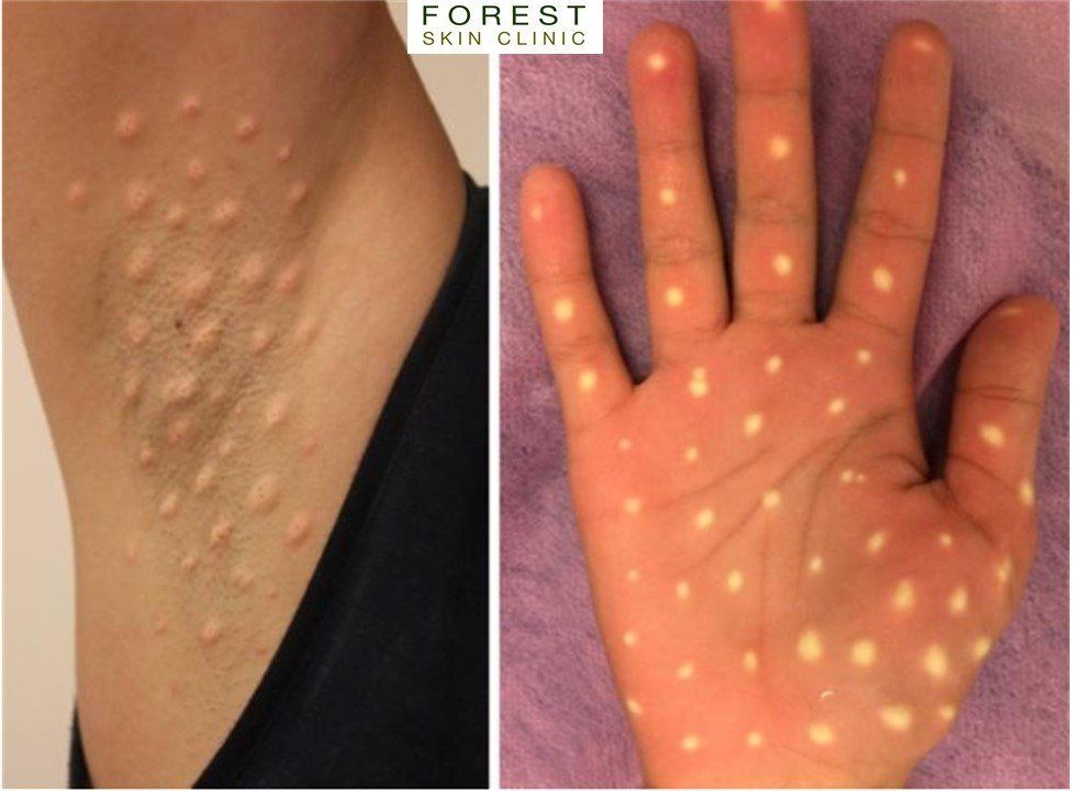 Forest Skin Clinic excessive sweating, hyperhidrosis