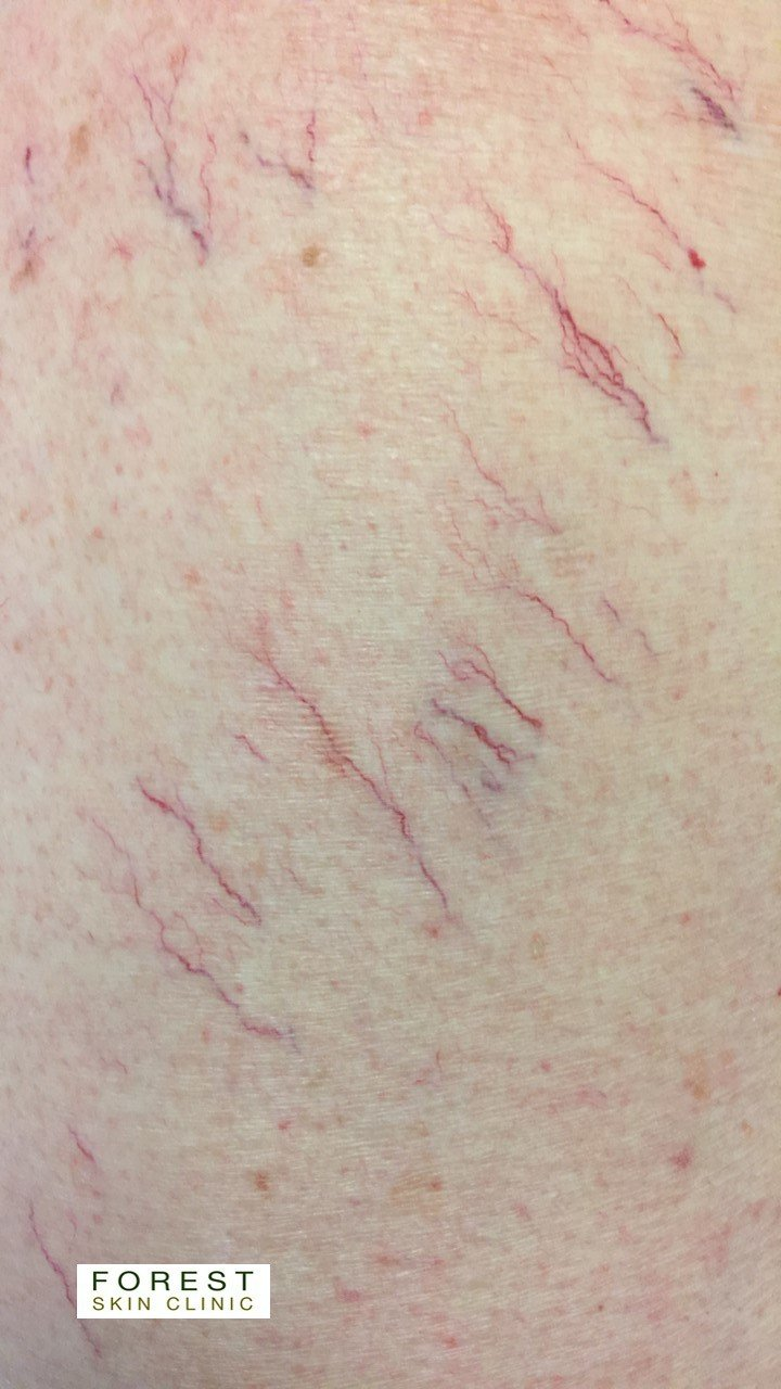 Forest Skin Clinic Microsclerotherapy for thread veins